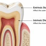 Why Do Teeth Turn Yellow? Causes and Common Factors