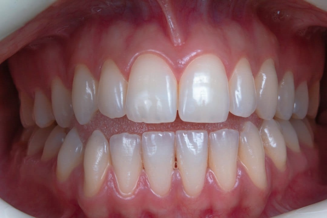 Close-up of teeth and gums illustrating the wisdom teeth recovery guide