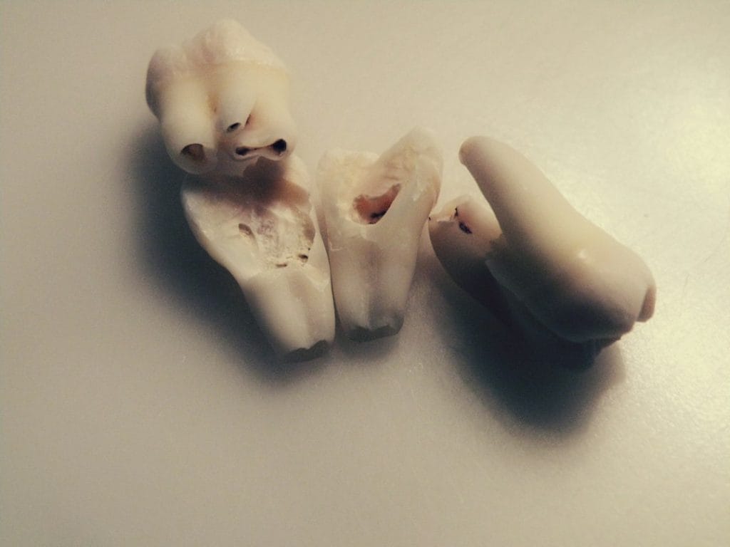soft foods after wisdom teeth removal