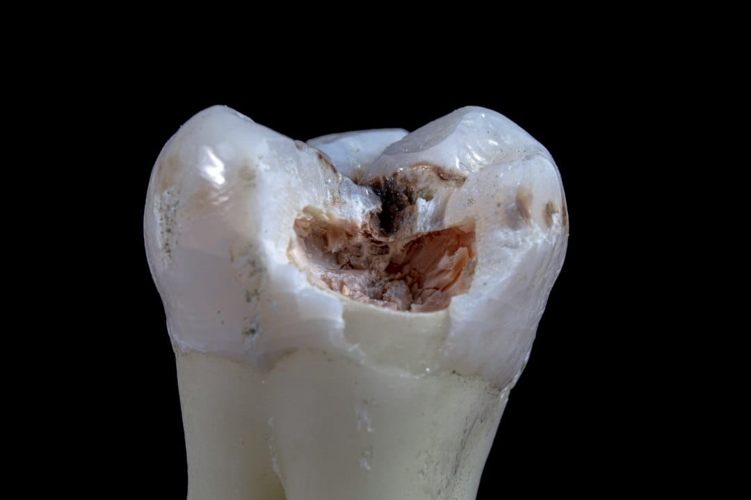 tooth remineralization and dental care