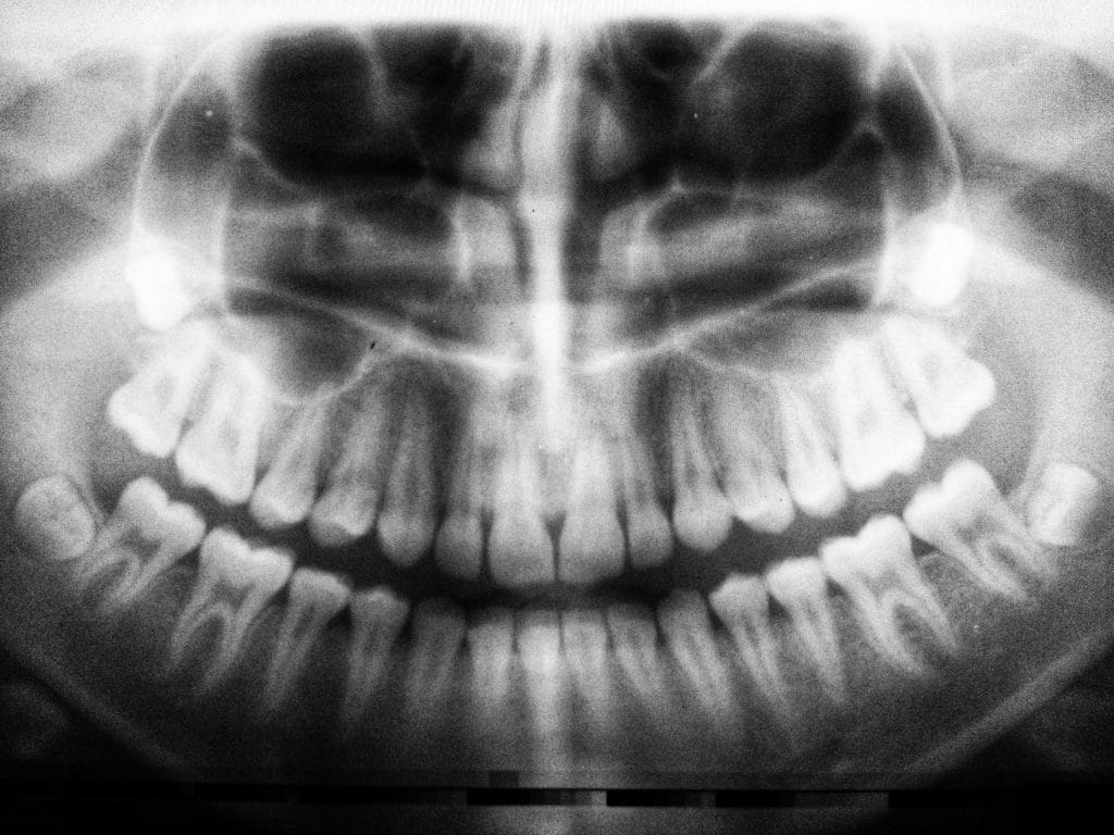 Dental panoramic X-ray reviewed during a wisdom teeth consultation