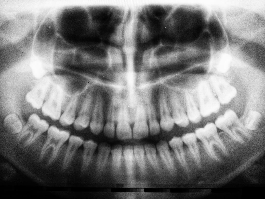 Dental patient holding their cheek to illustrate discomfort that may need dental evaluation after wisdom teeth removal