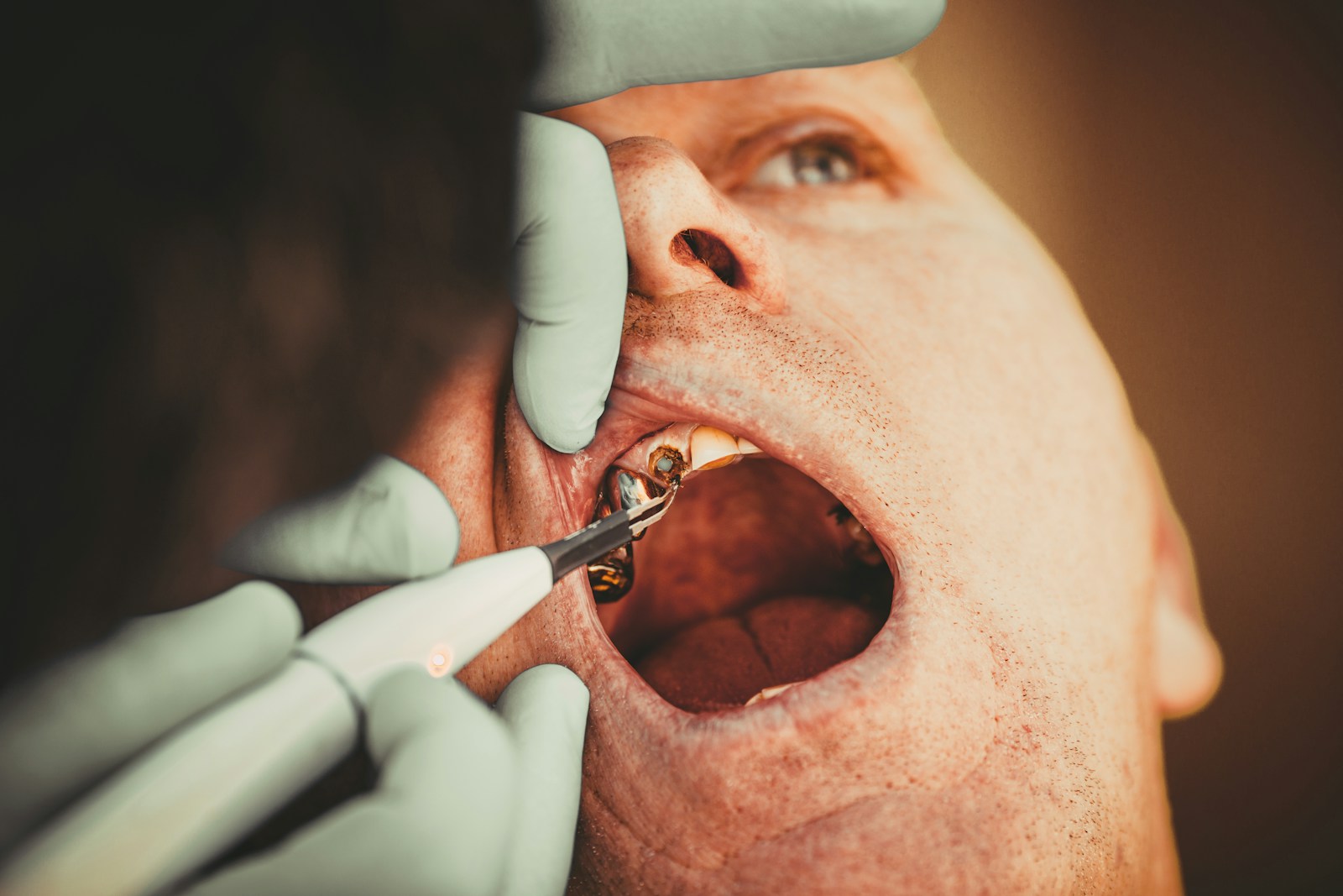 Dental professional performing a procedure in a clinical setting, illustrating what happens during wisdom teeth removal
